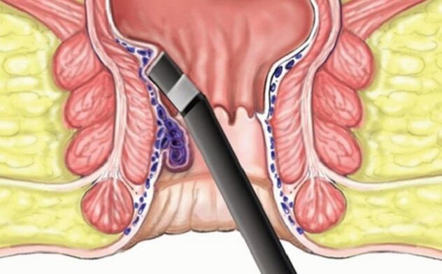 Hemorrhoids coagulate